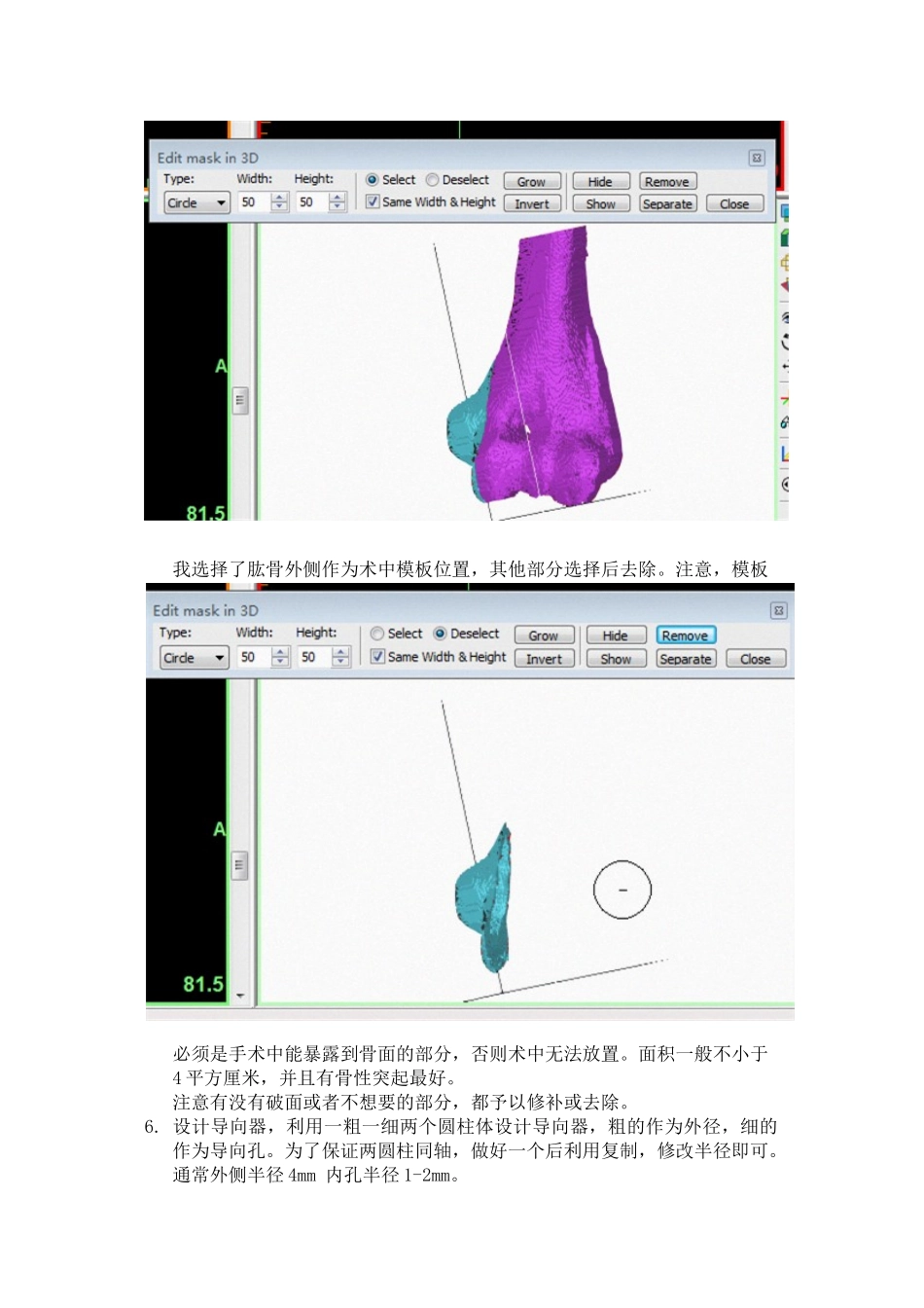 mimics手术导板制作-简单易行_第3页