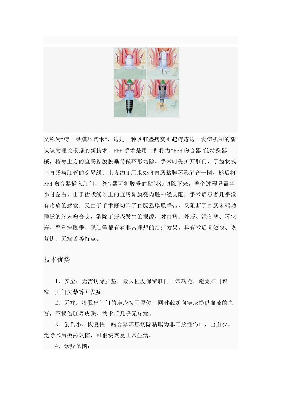 PPH环切术_第2页