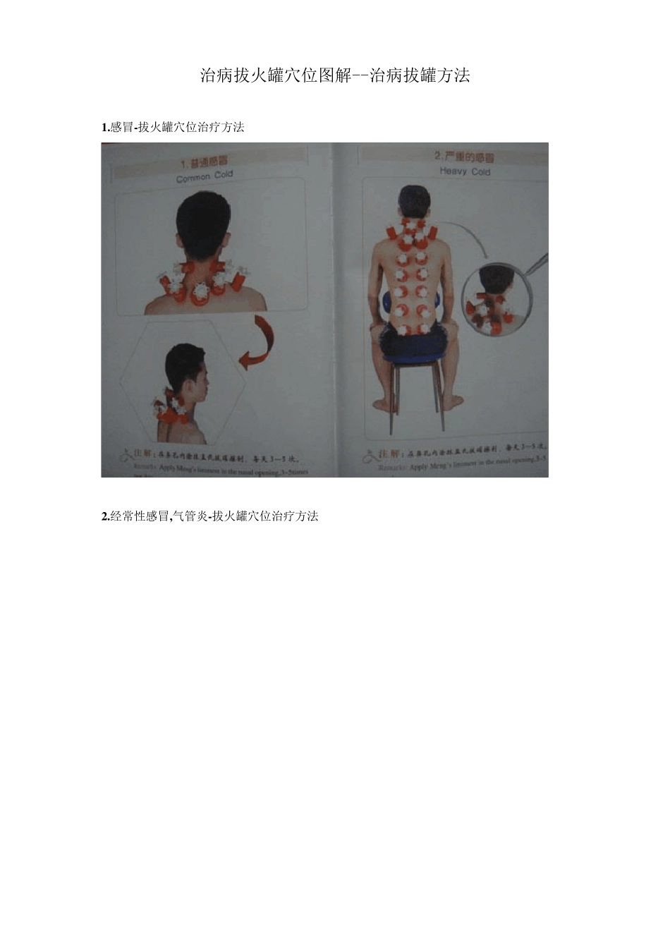 治病拔火罐穴位图解_第1页