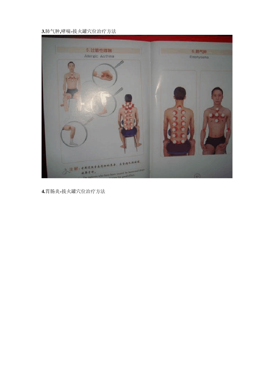 治病拔火罐穴位图解_第2页