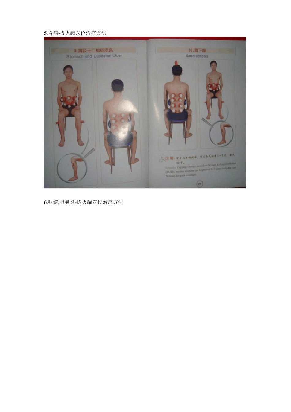 治病拔火罐穴位图解_第3页