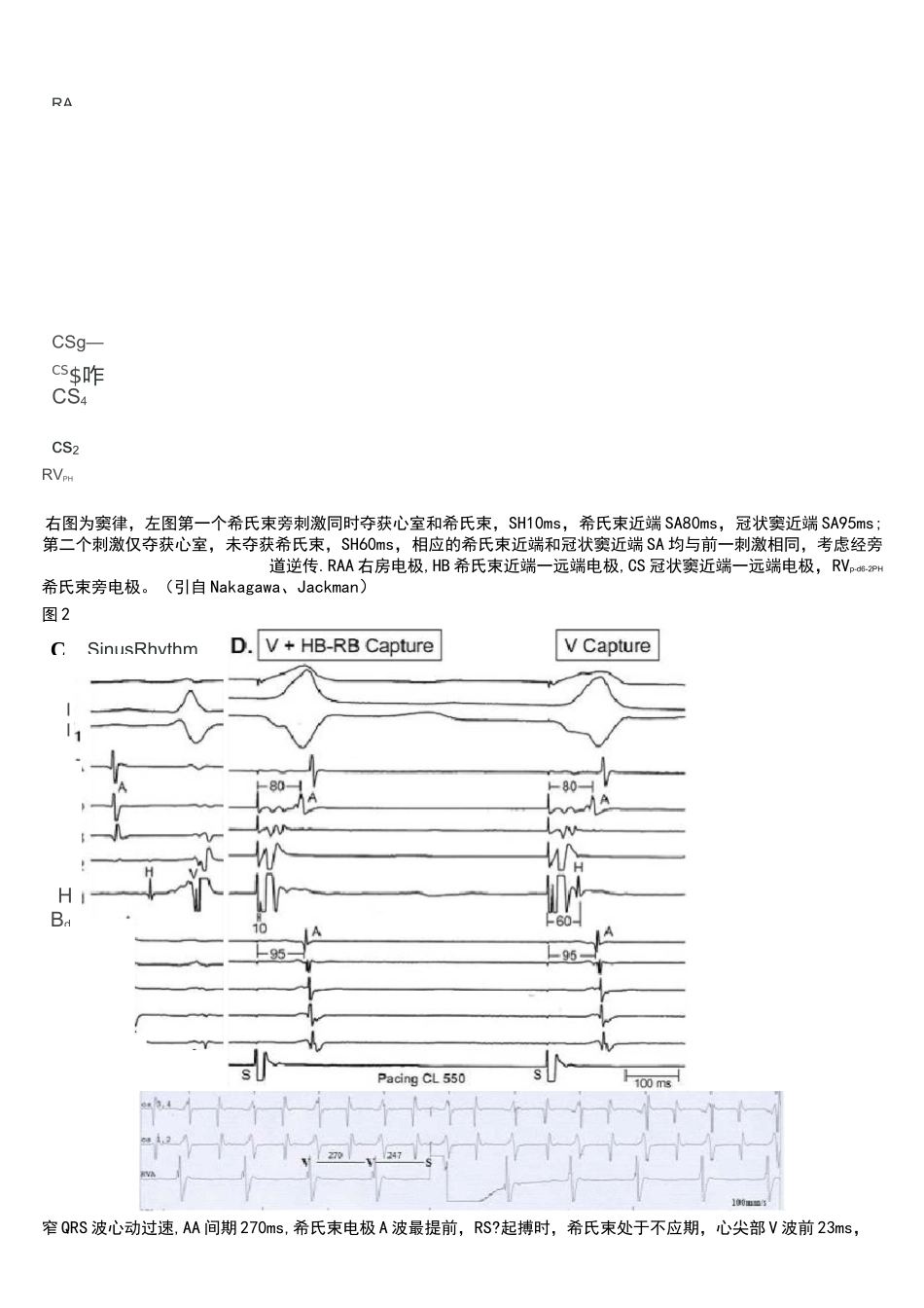 (完整)室上性心动过速鉴别诊断的常用心内电生理程序刺激方法_第3页