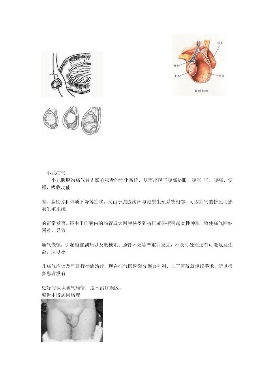 疝气(鞘膜积液)症状及验方_第2页