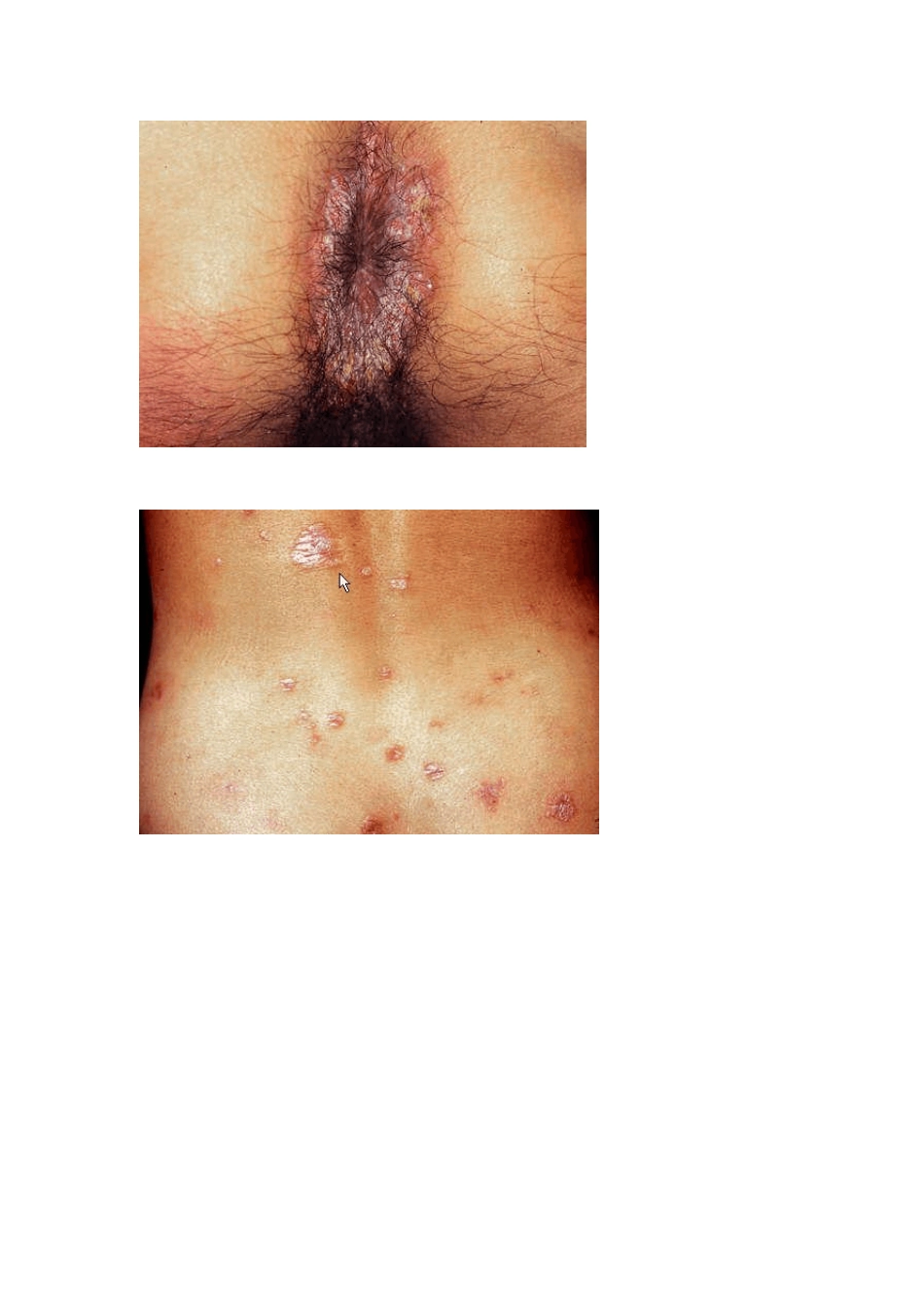 皮肤性病图谱_第3页