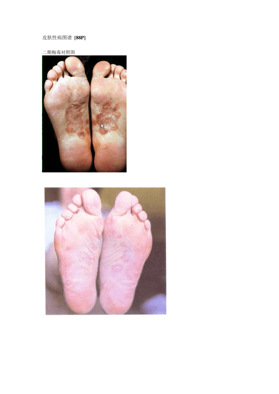皮肤性病图谱_[88P]_第1页