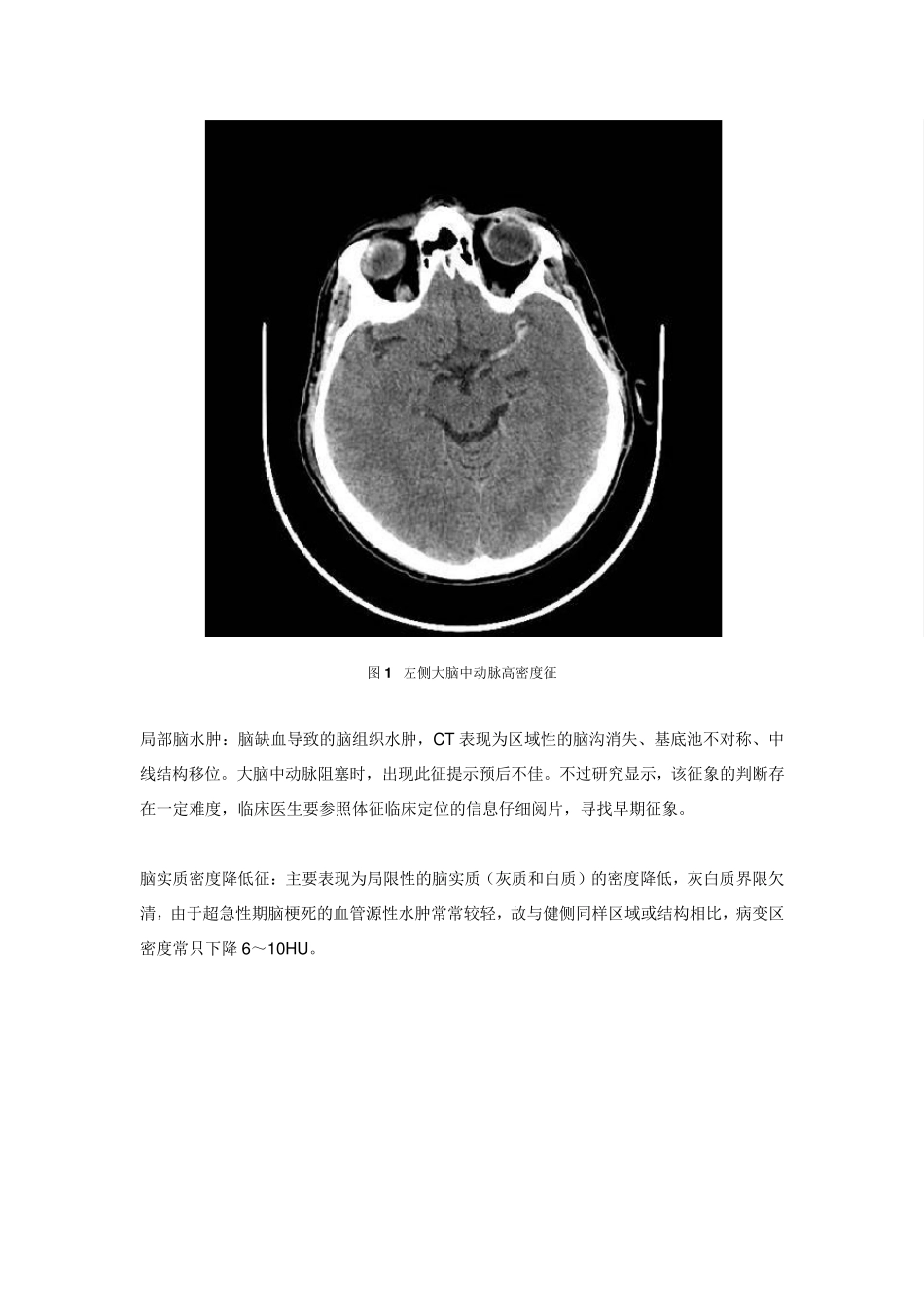 看图说话：缺血性脑卒中超急性期的影像学特点_第2页
