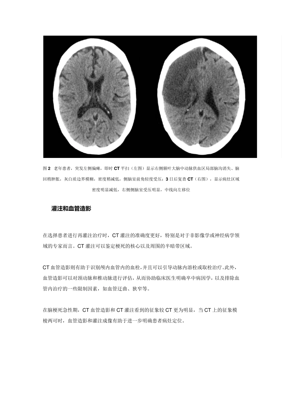 看图说话：缺血性脑卒中超急性期的影像学特点_第3页