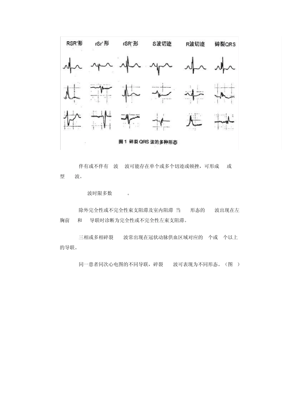 碎裂QRS波_第2页