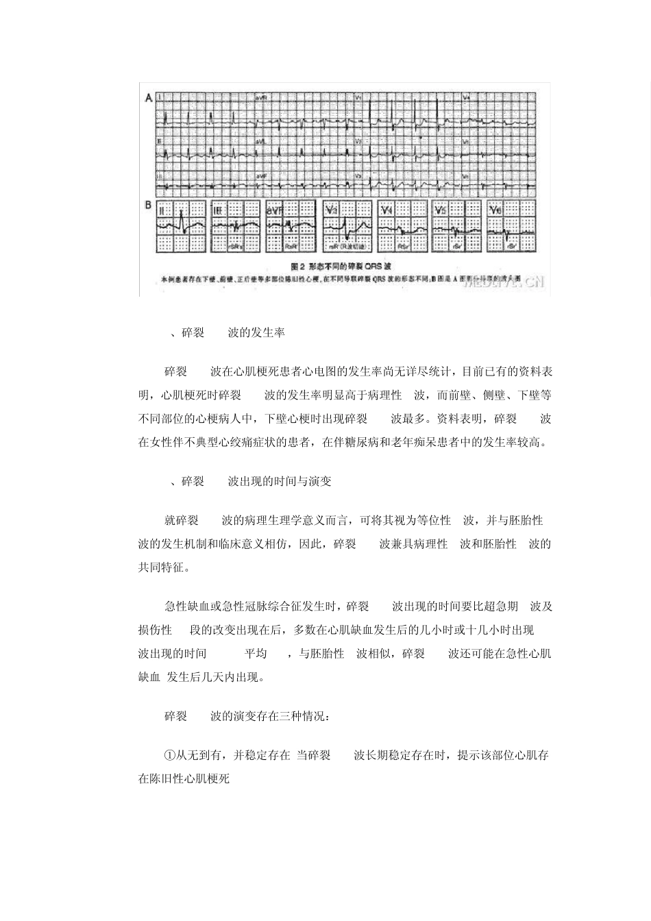 碎裂QRS波_第3页