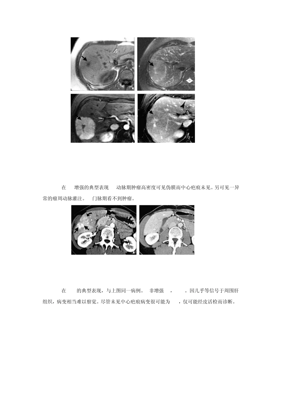 肝脏疾病典型影像学表现(附图例)_第3页