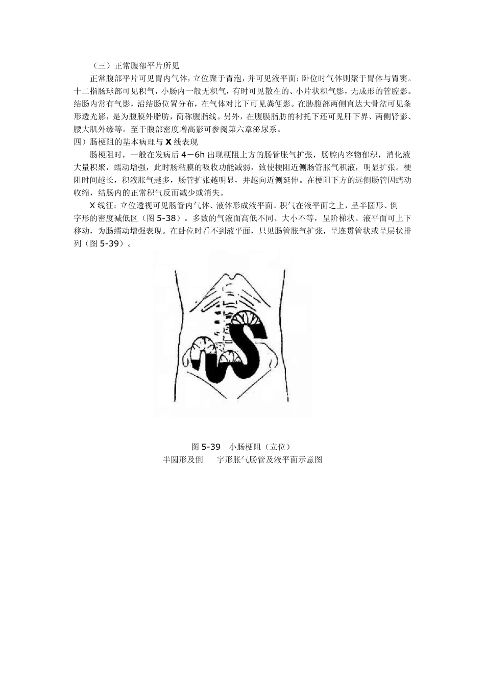 肠梗阻(Intestinalobstruction)X线诊断_第2页