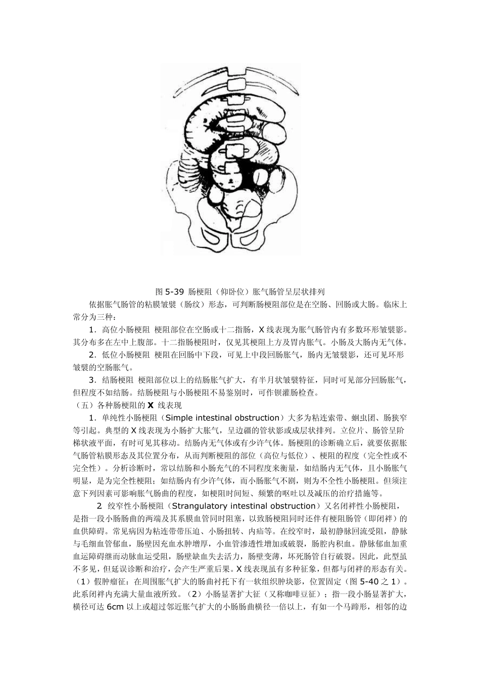肠梗阻(Intestinalobstruction)X线诊断_第3页