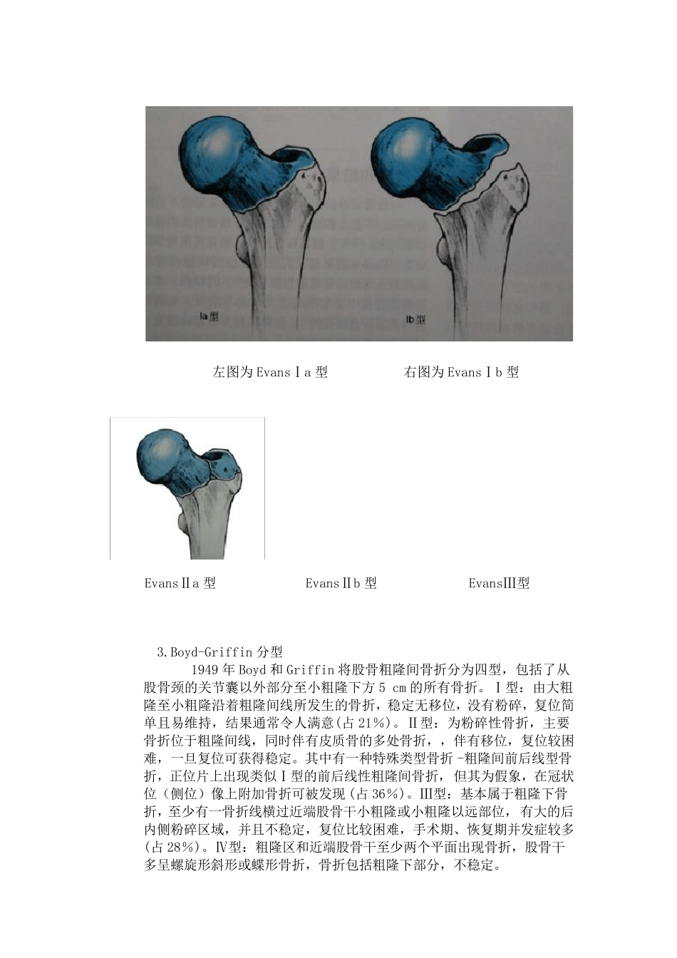 股骨粗隆间骨折(intertrochantericfracture)_第3页