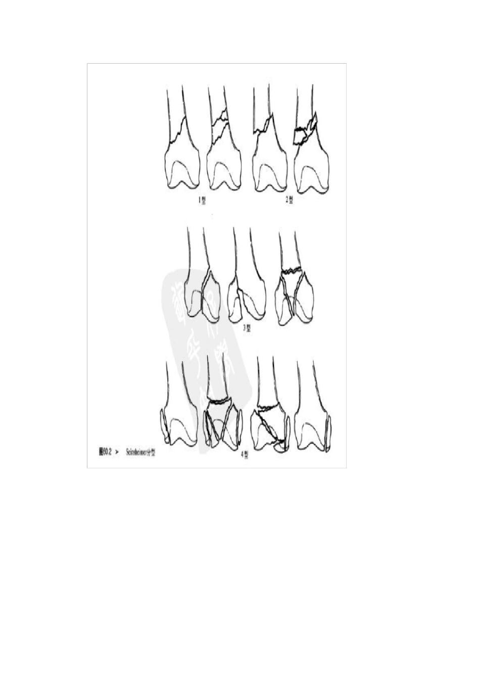 股骨髁上骨折分型_第3页