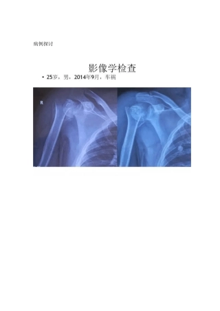 肩关节反向假体置换术技巧