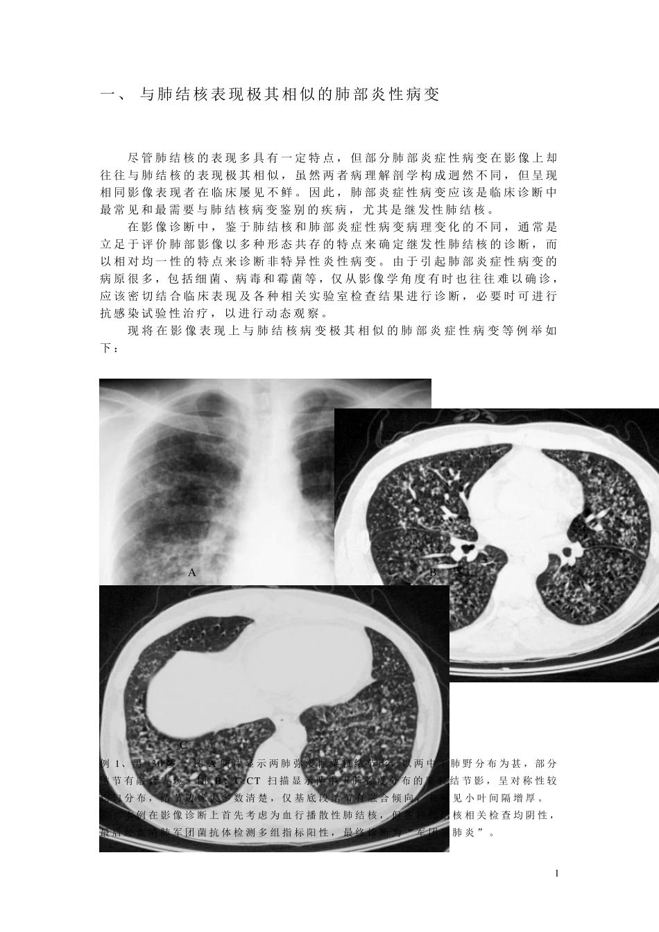 肺结核不典型影像学表现的分析与诊断_第1页