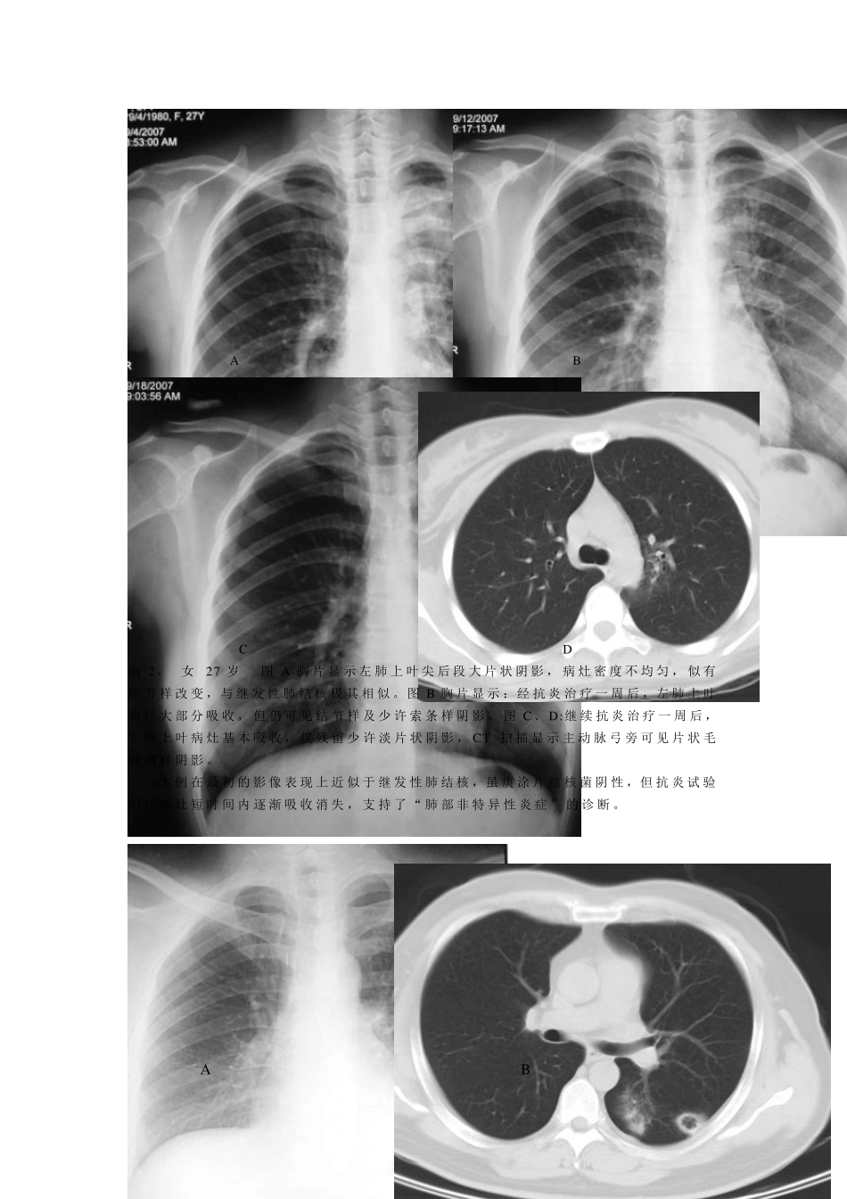 肺结核不典型影像学表现的分析与诊断_第2页