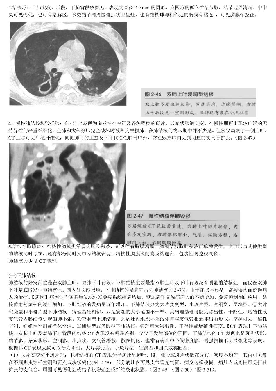 肺结核少见CT表现_第2页