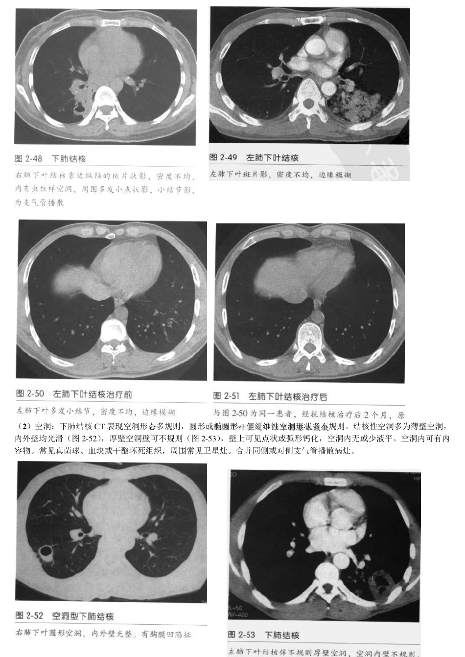 肺结核少见CT表现_第3页
