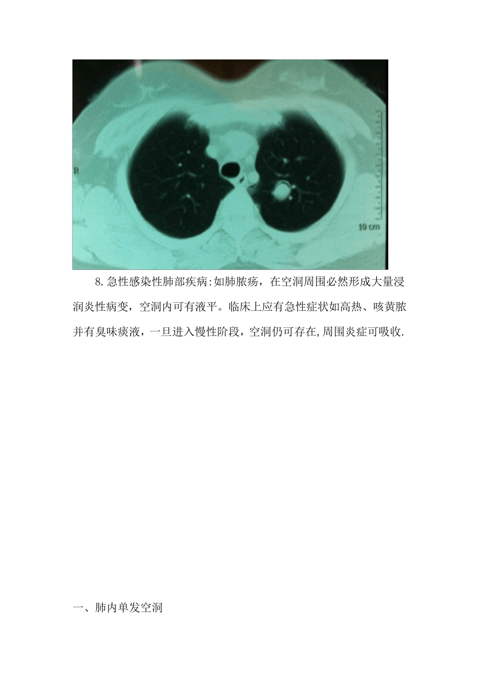 肺部空洞的鉴别诊断_第3页