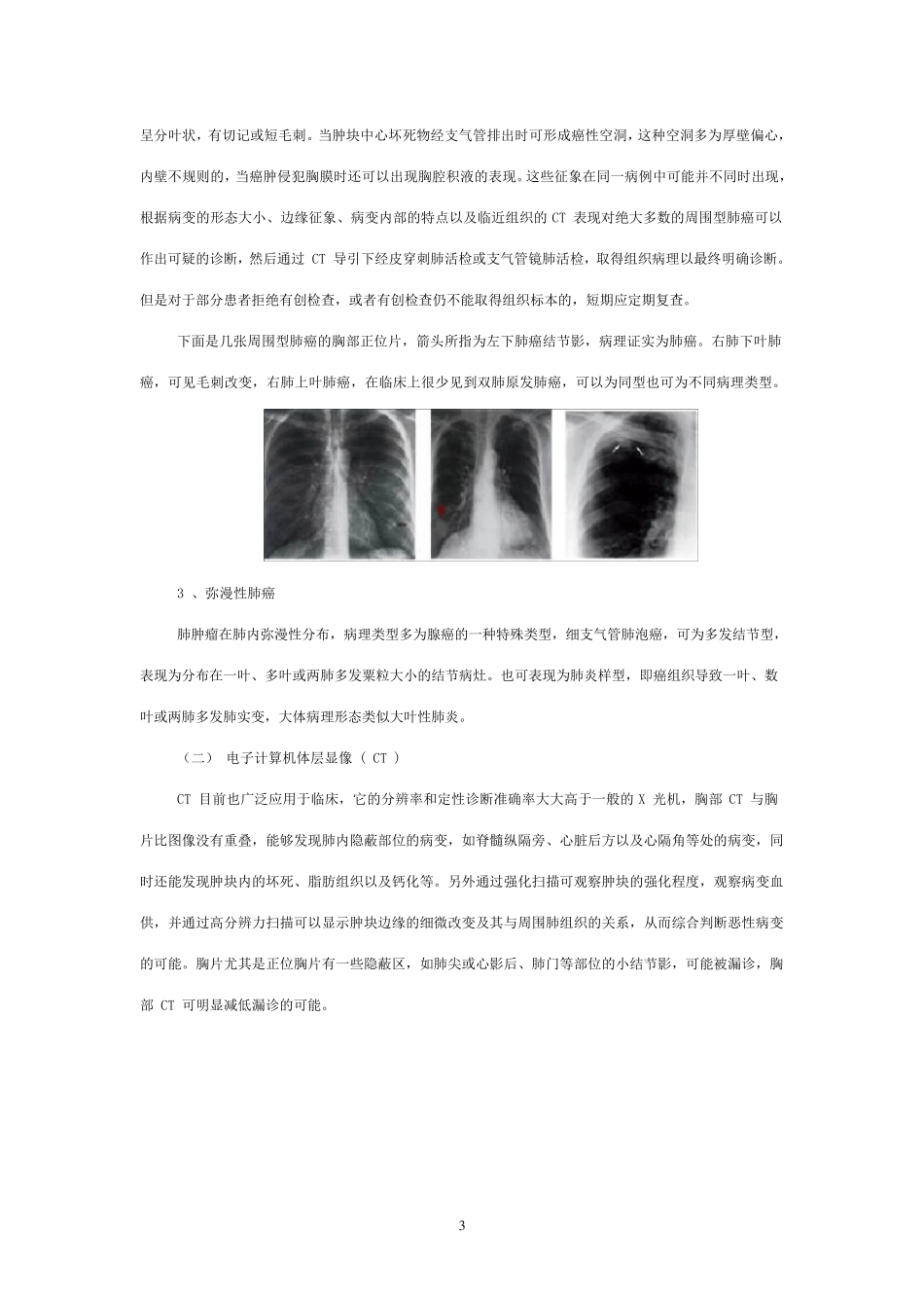 肺部肿瘤影像诊断_第3页