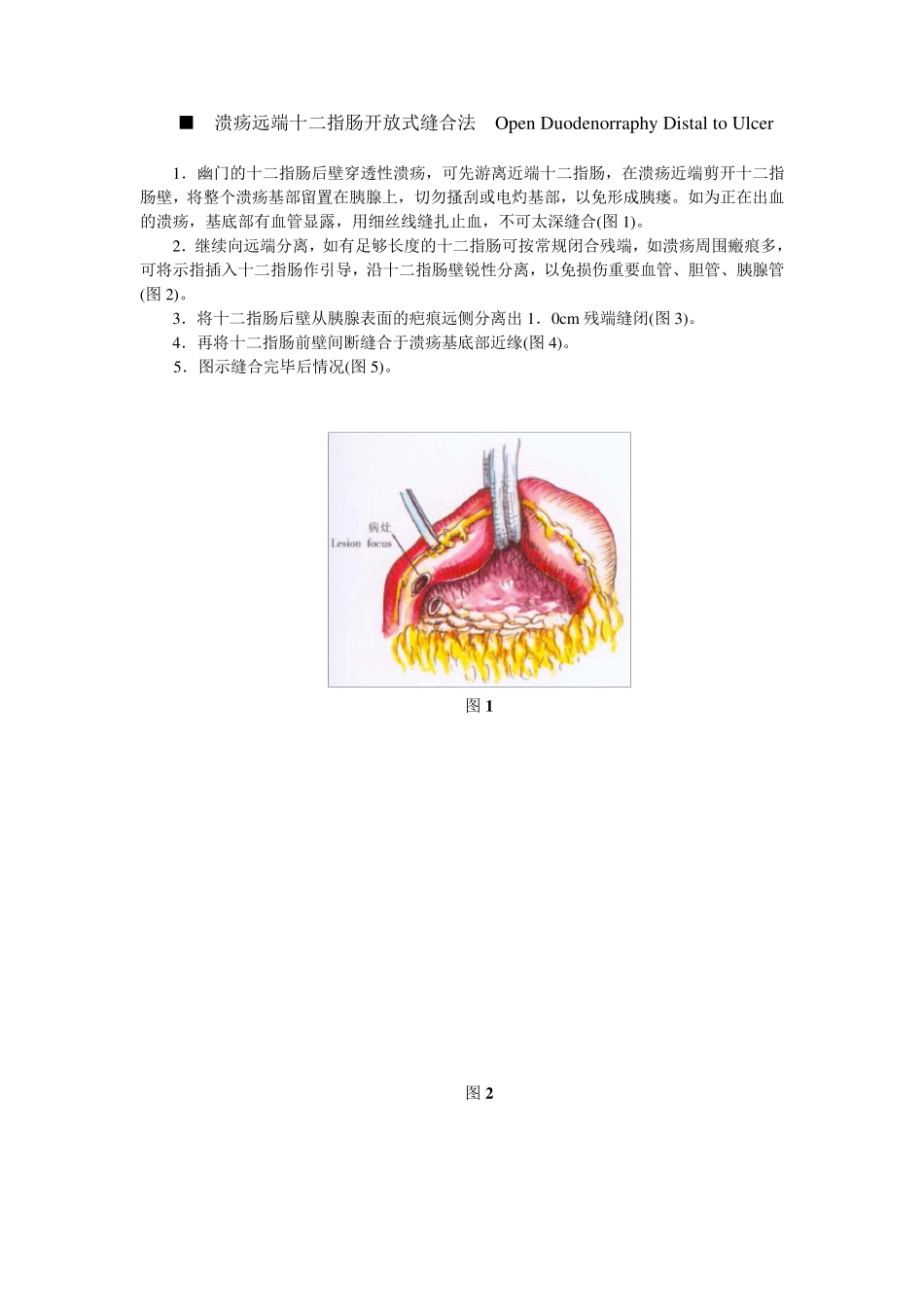 胃、十二指肠溃疡切除的非常规术式_第2页