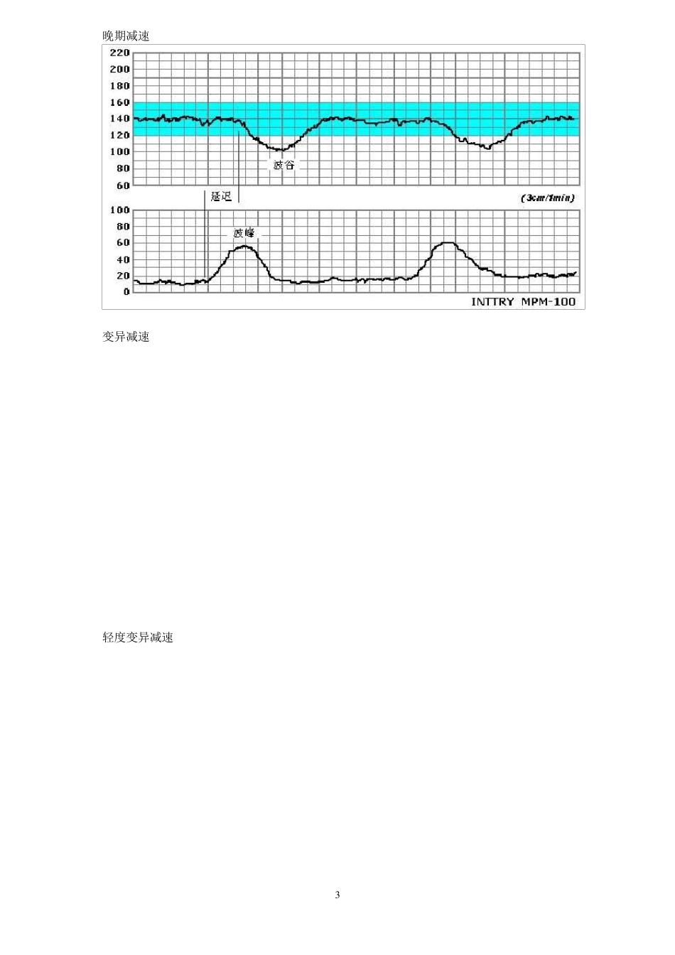 胎心监护图谱_第3页