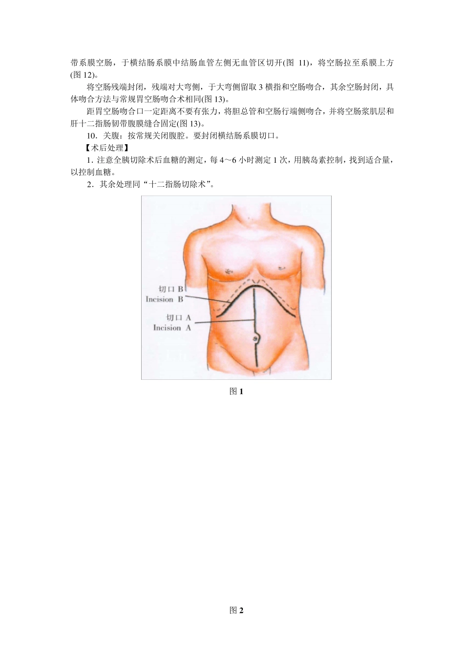 胰腺全切除术_第2页