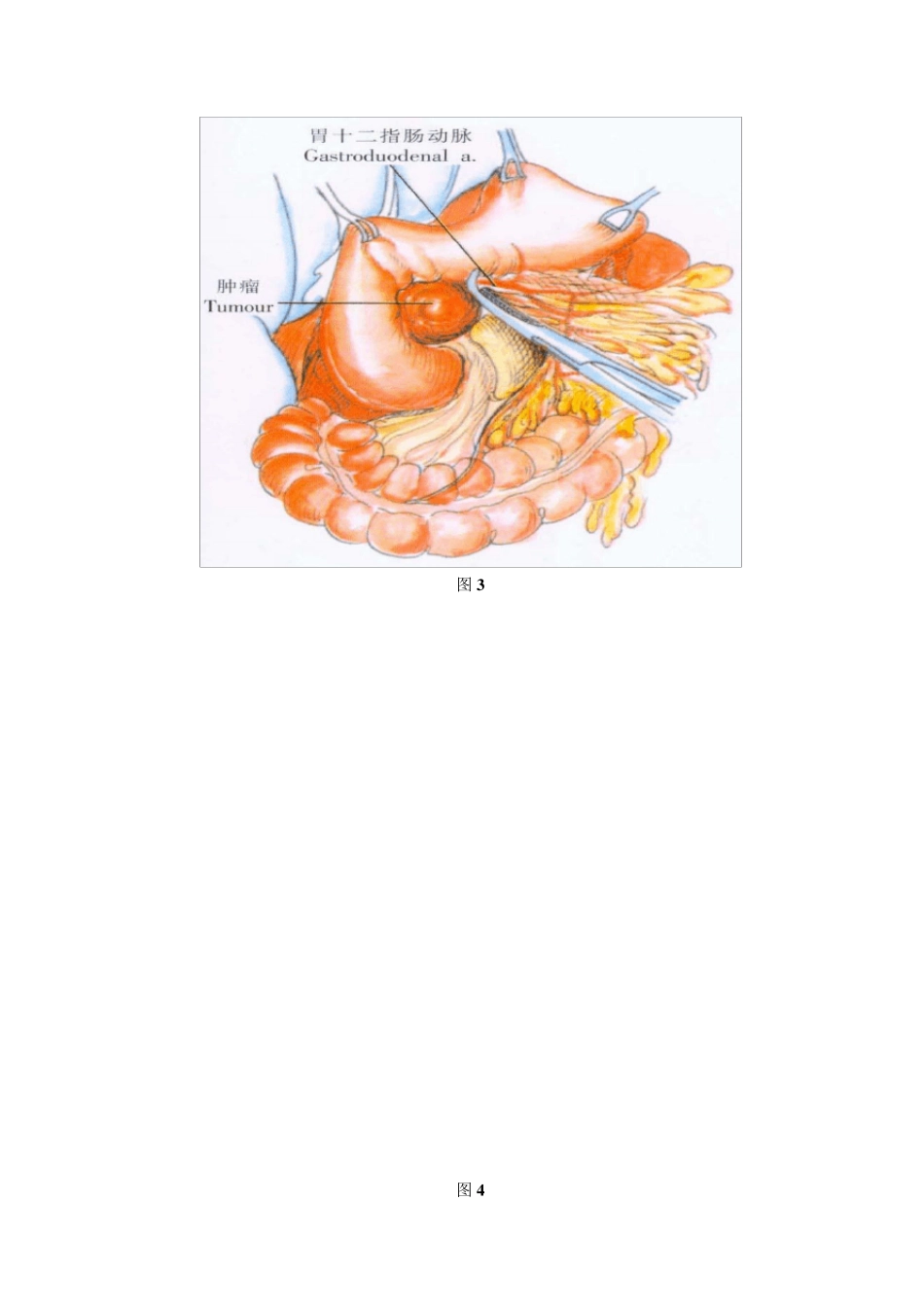 胰腺全切除术_第3页
