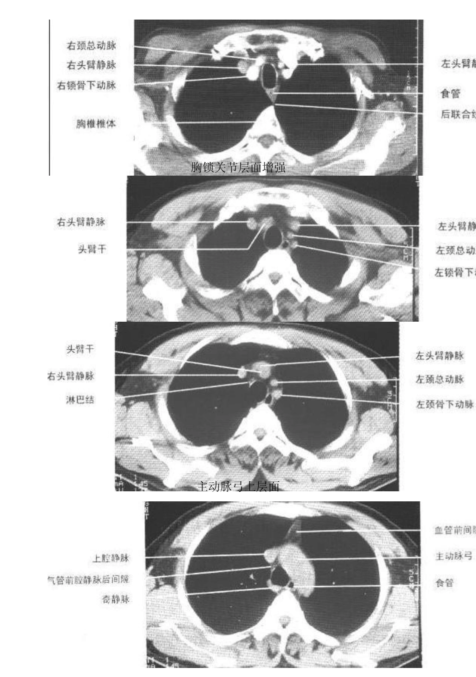 胸部CT图谱_第2页