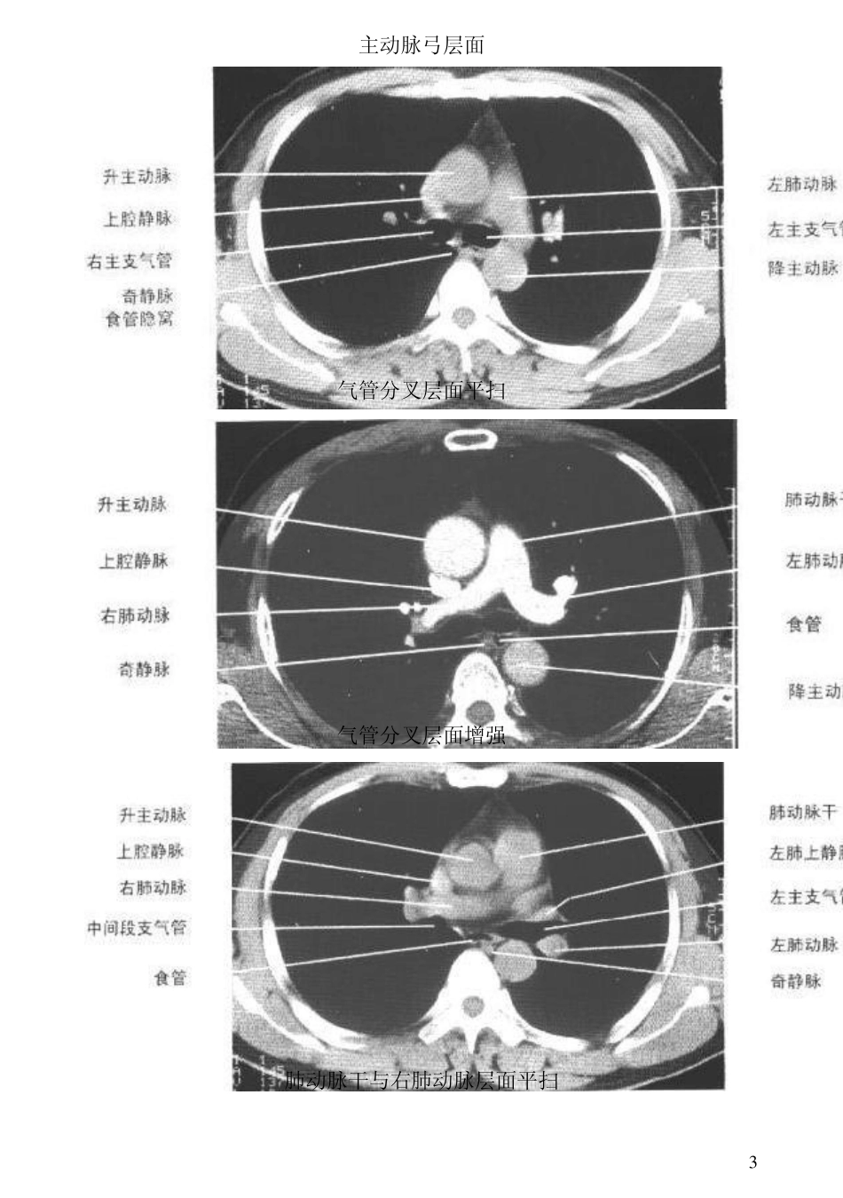 胸部CT图谱_第3页