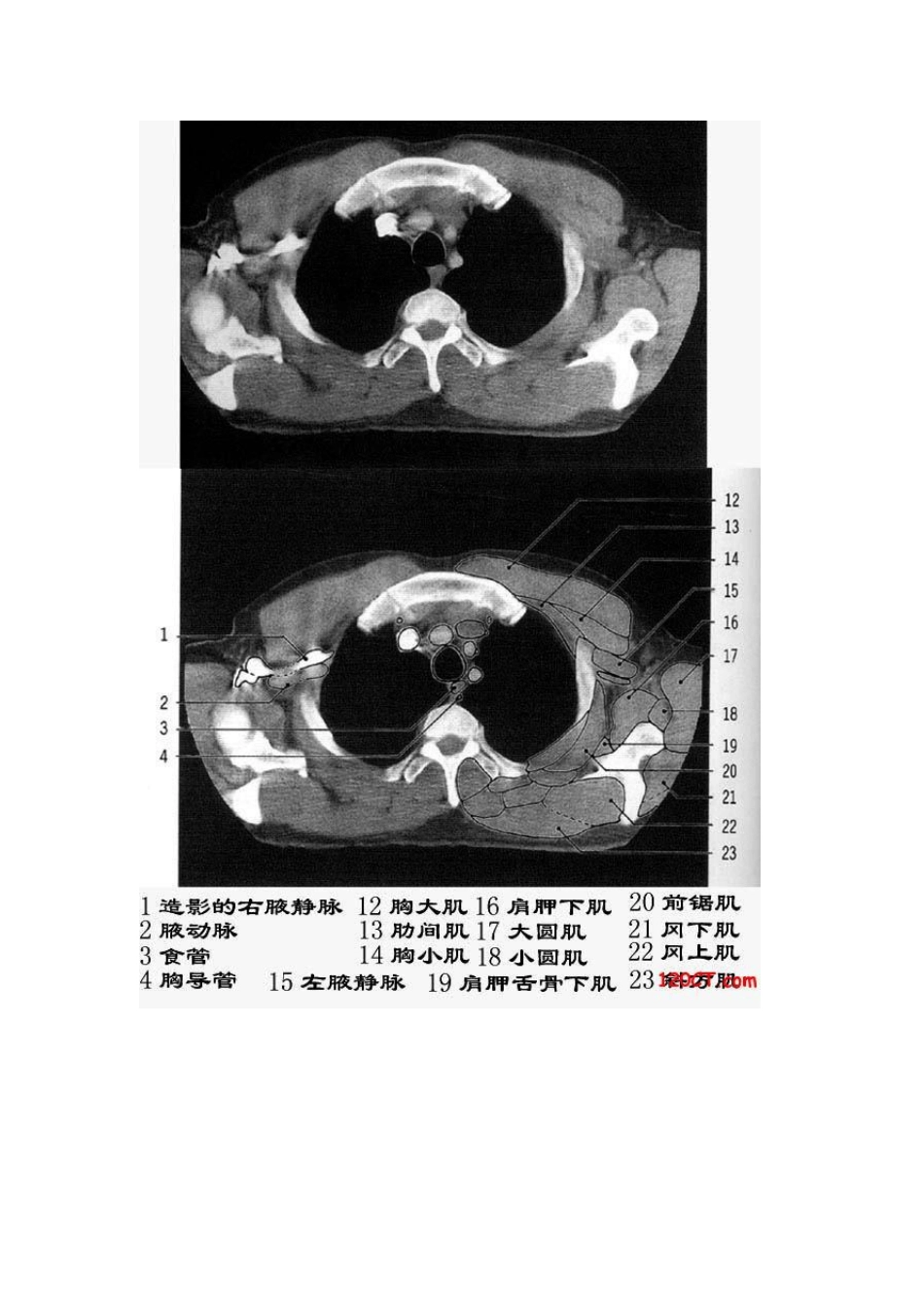 胸部CT解剖(软组织窗)_第2页