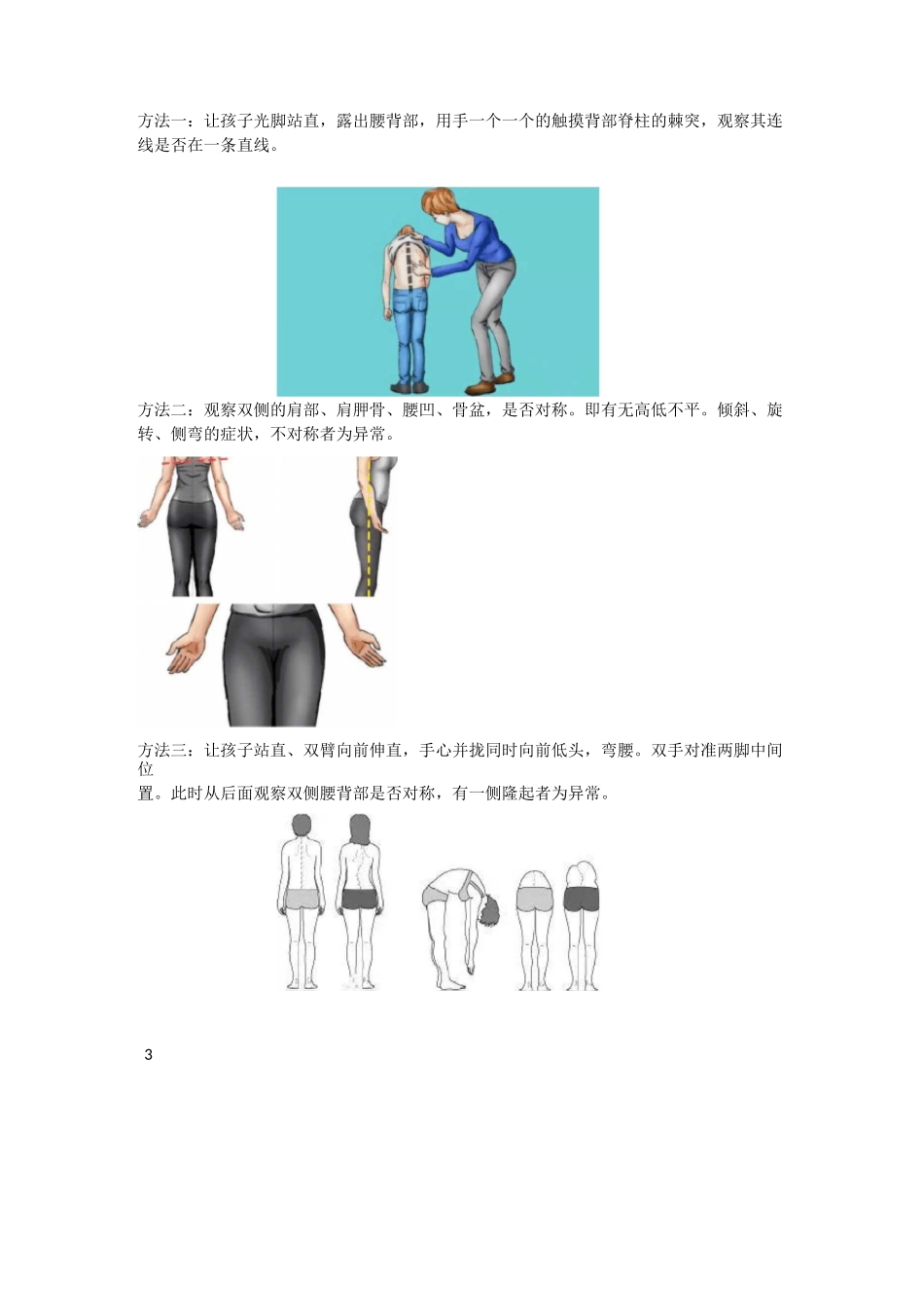 科普每20个初中生,就有1个存在脊柱侧弯？_第2页