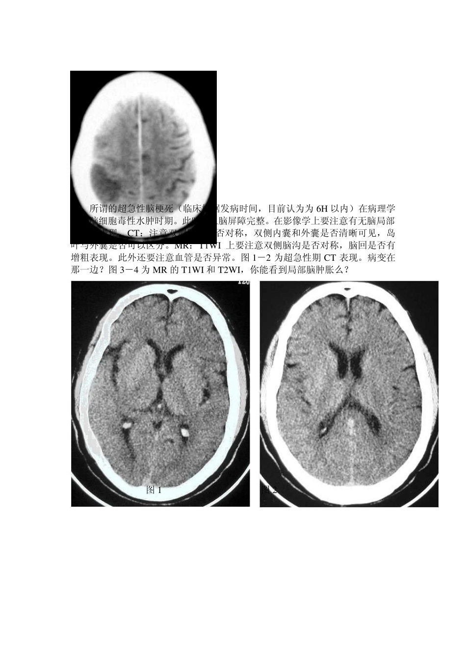 脑梗死超早期CT表现(体现水平的时候到了!!)_第3页