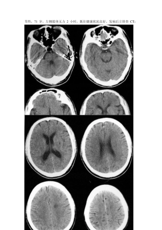 脑梗死超早期CT表现(体现水平的时候到了!!)