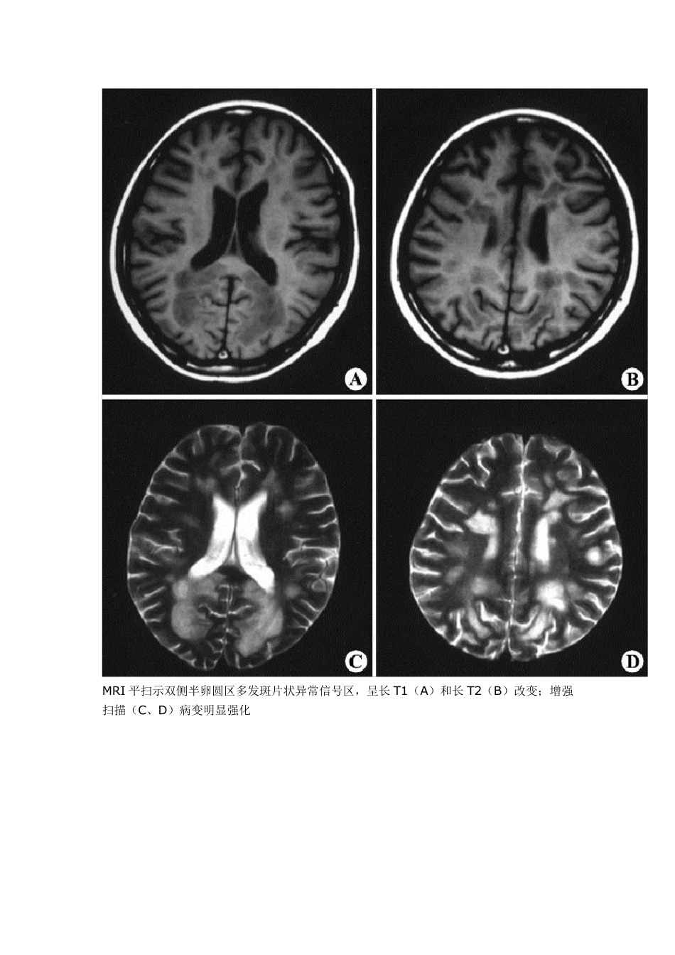 脑白质病变的影像学鉴别诊断_第2页