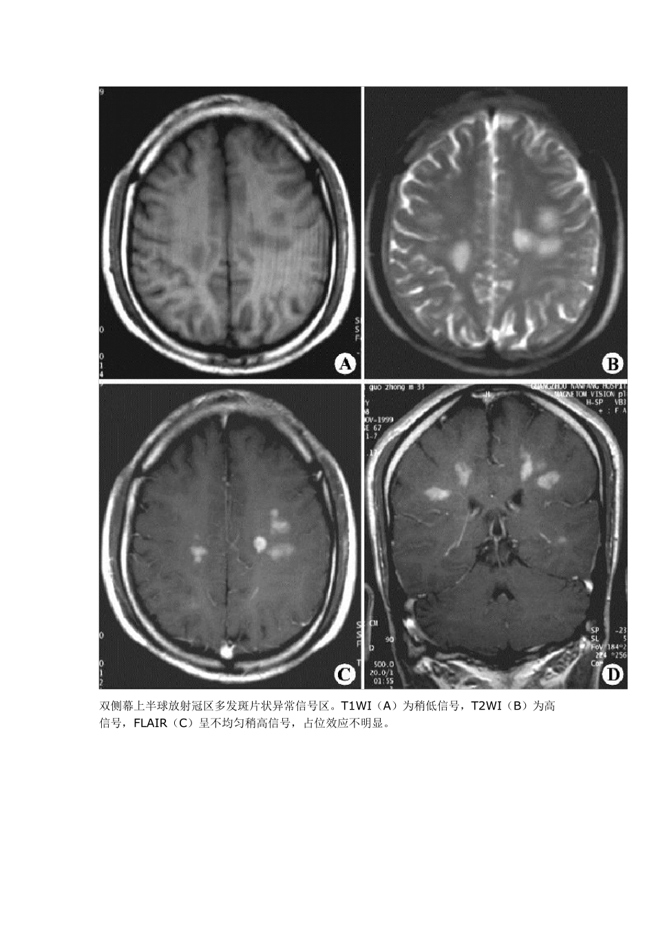 脑白质病变的影像学鉴别诊断_第3页