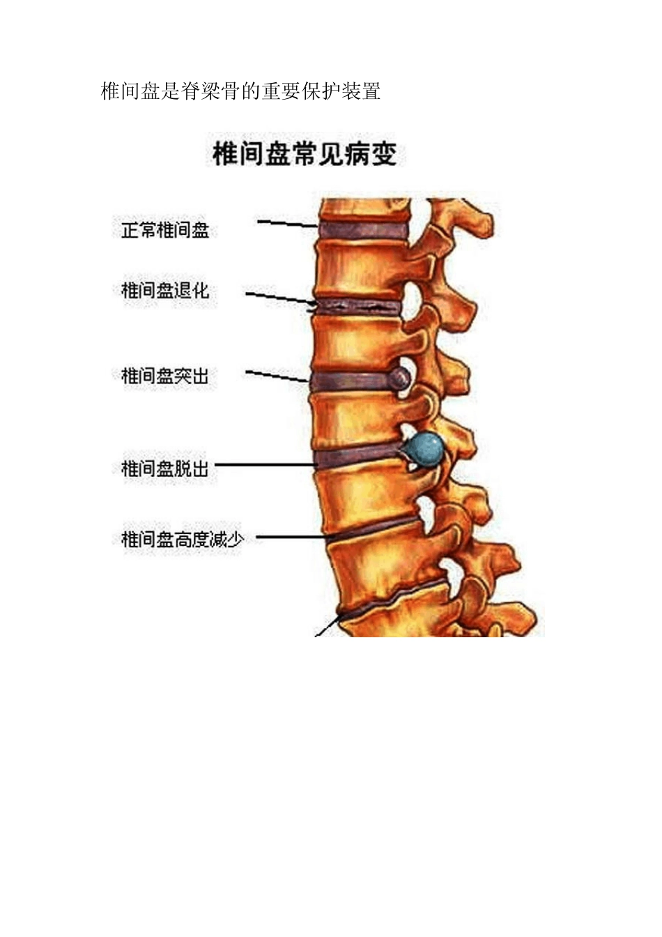 腰椎间盘突出有什么感觉_第2页