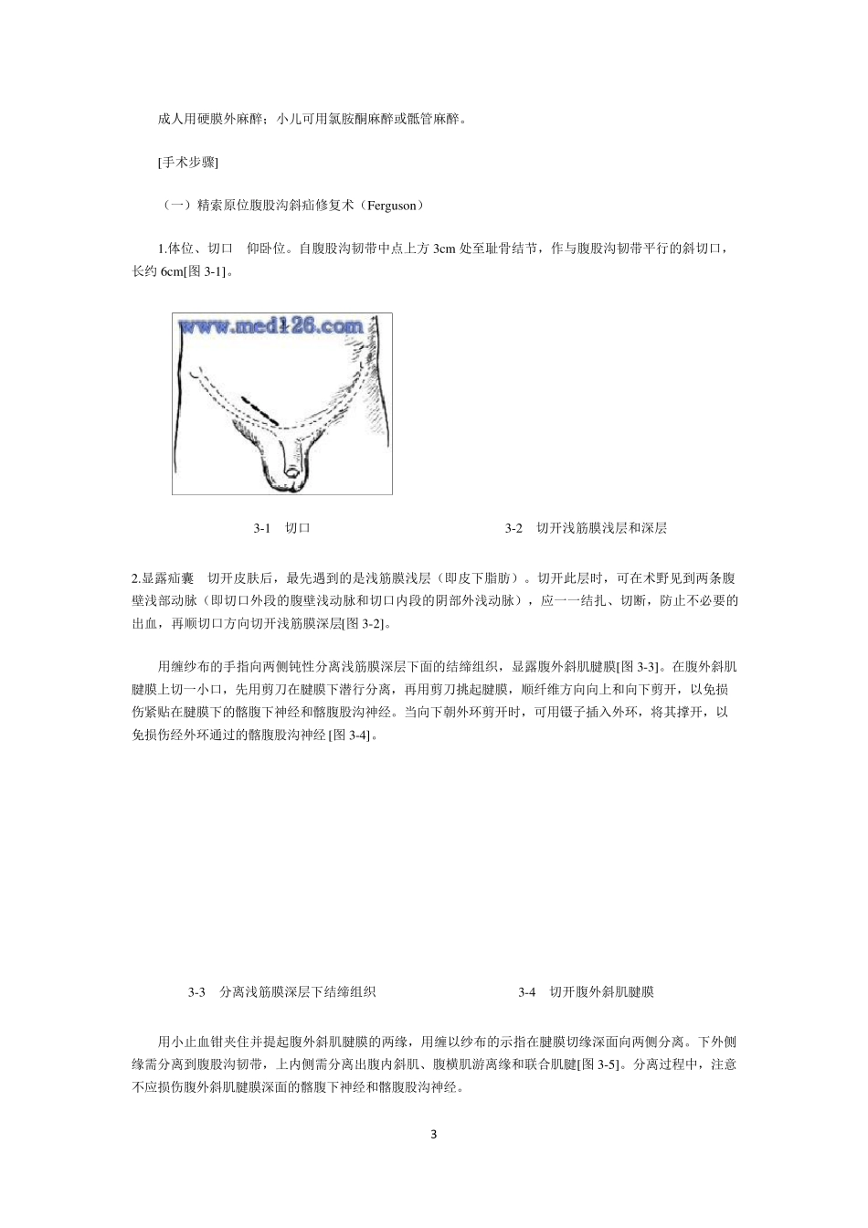 腹股沟斜疝手术_第3页