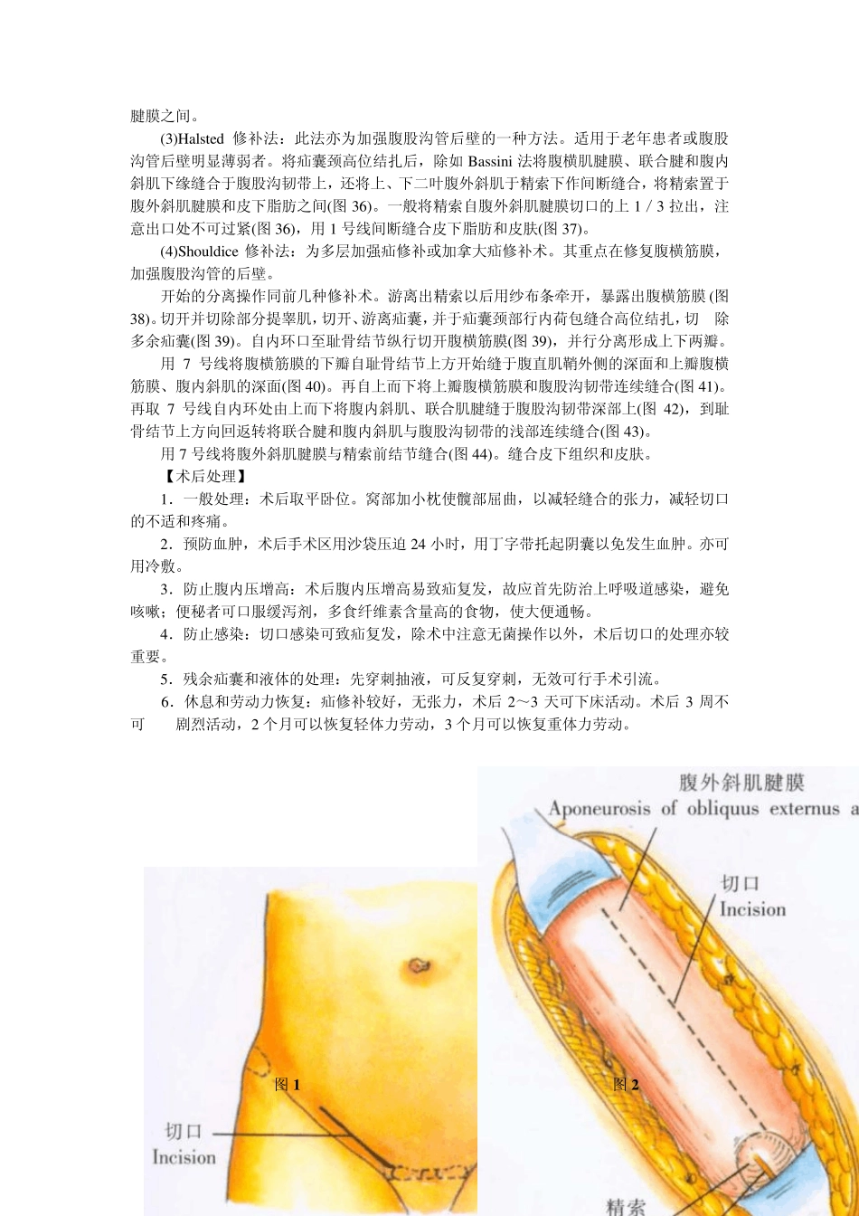 腹股沟斜疝修补术_第3页