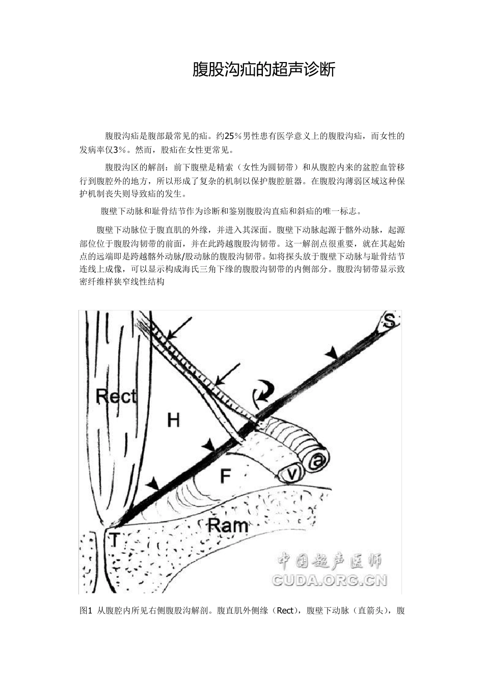 腹股沟疝的超声诊断_第1页