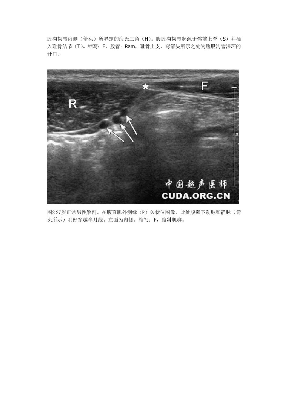 腹股沟疝的超声诊断_第2页