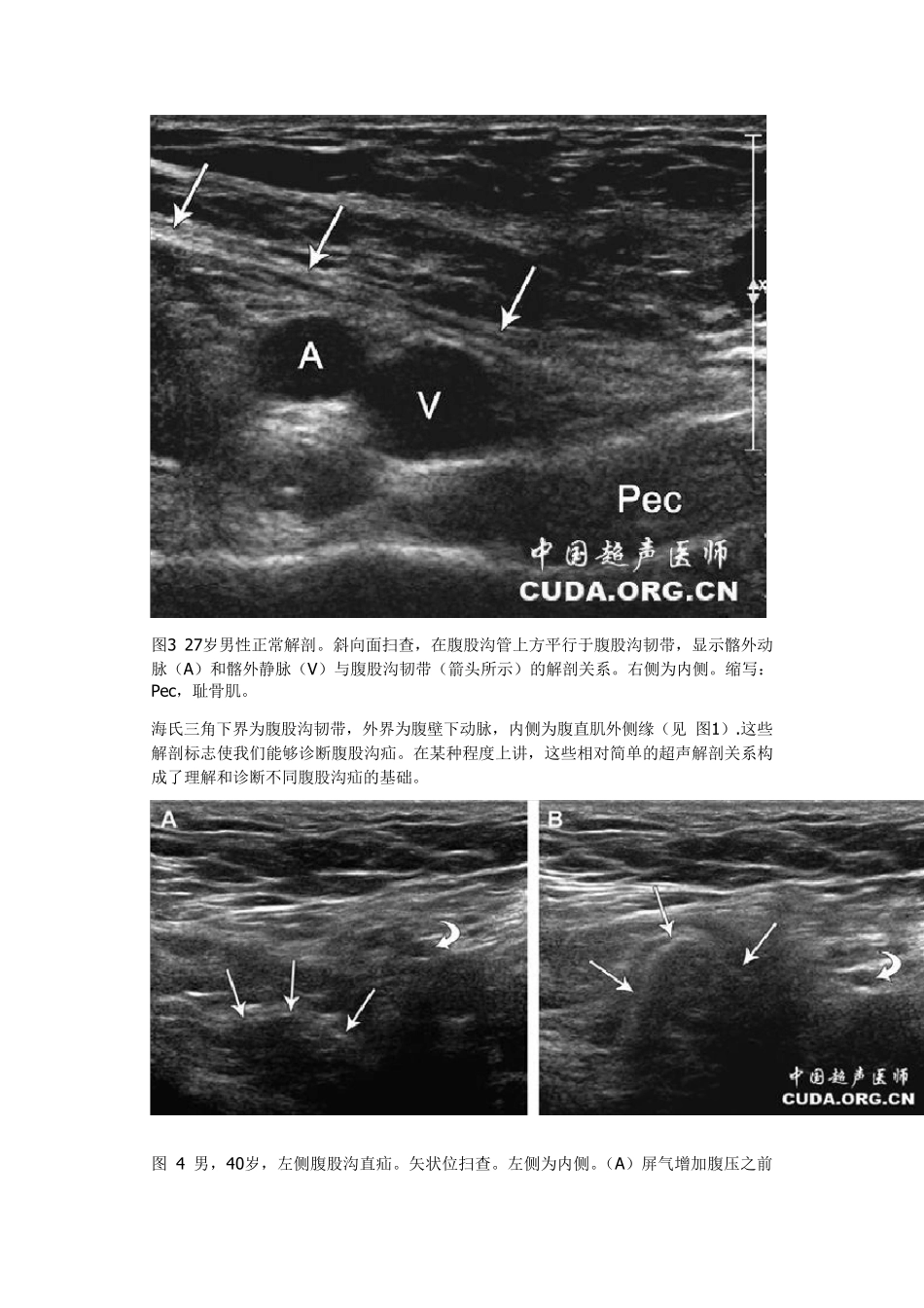腹股沟疝的超声诊断_第3页