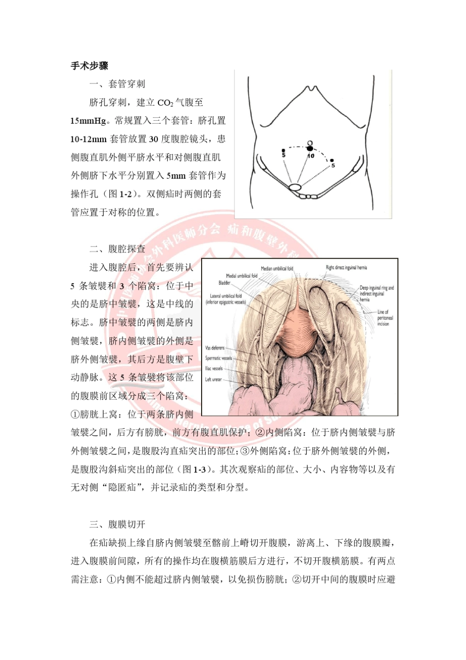 腹股沟疝腹腔镜手术的规范化操作指南_第2页