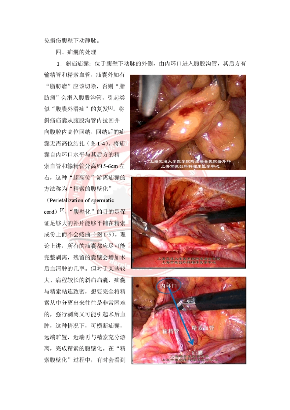 腹股沟疝腹腔镜手术的规范化操作指南_第3页
