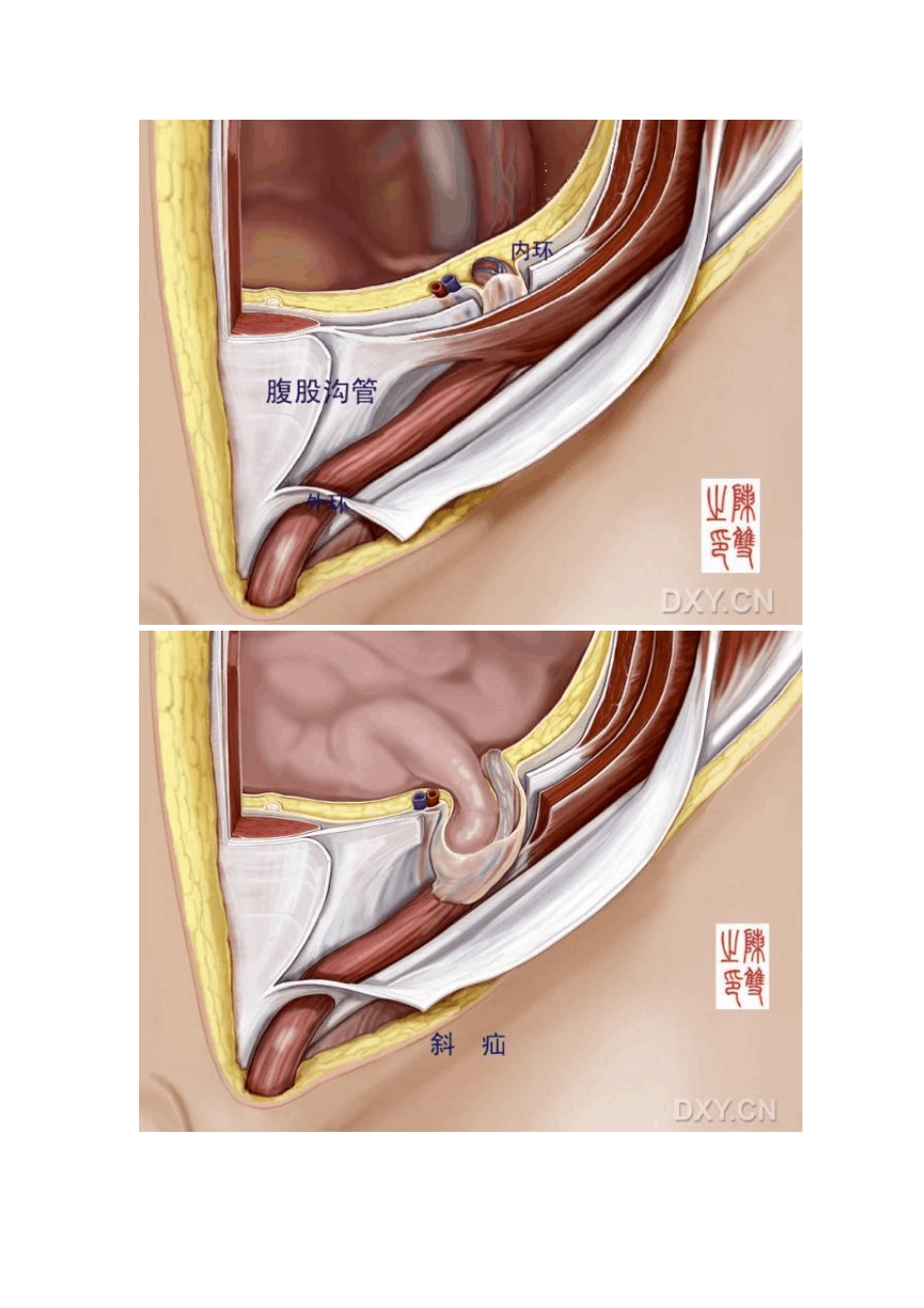 腹股沟管解剖_第3页