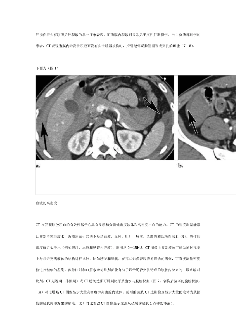 腹部出血：腹腔积血的CT表现_第2页