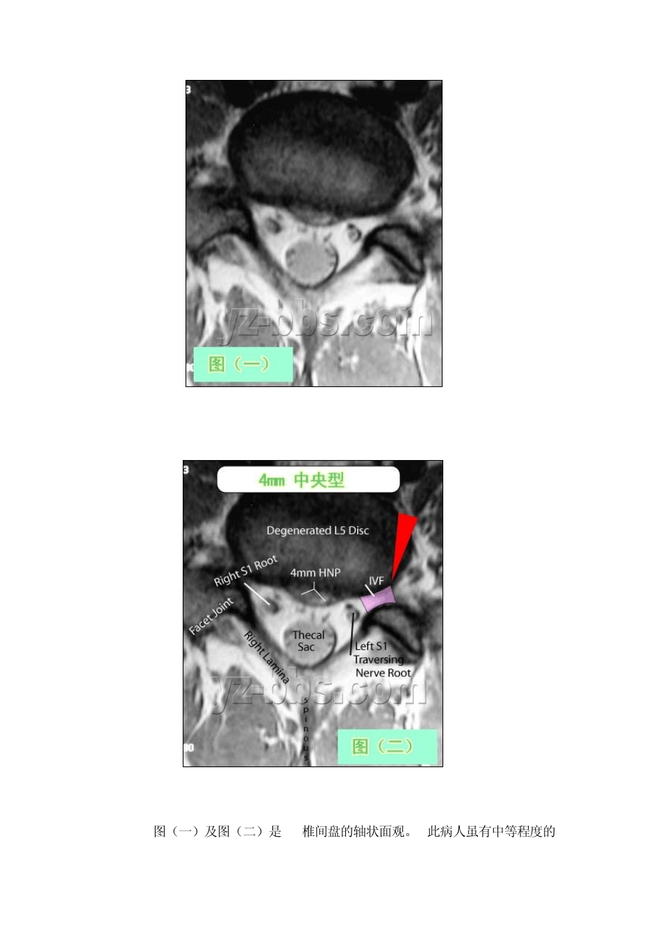 自己学会看腰椎间盘突出CT和MRI磁共振片子的超好教程_第3页