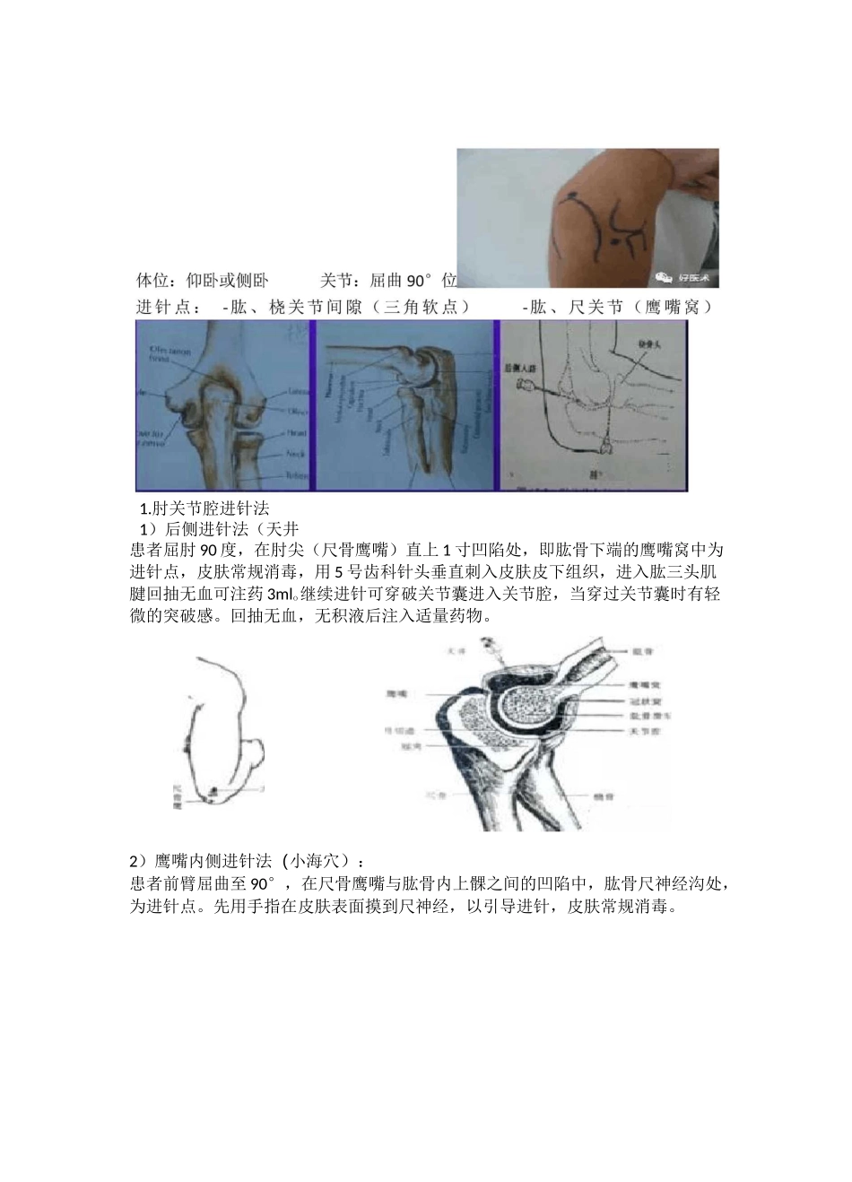 关节腔穿刺精讲课件(膝关节、肘关节、腕关节、踝关节)_第3页