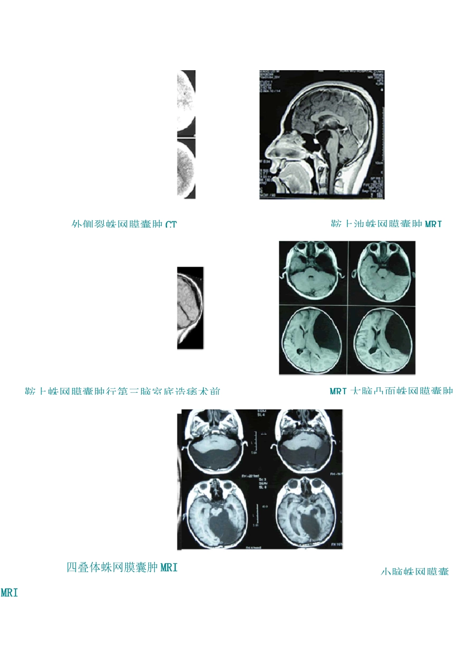 蛛网膜囊肿的定义_第3页